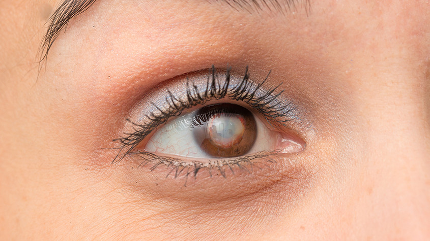 Cataract Treatment